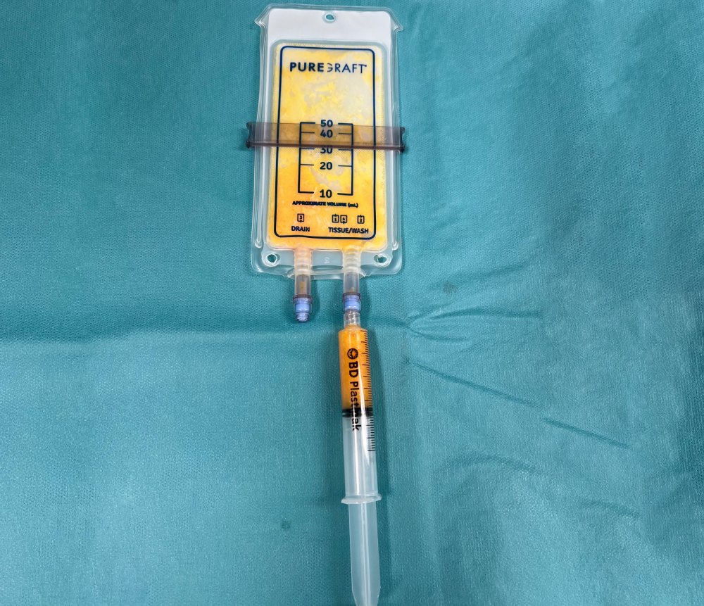 Wie funktioniert eine Lipofilling-Behandlung